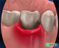 Protection from periodontitis and related chronic diseases