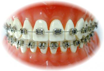 Novel antibacterial orthodontic bracket cement developed