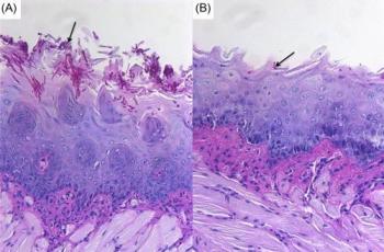 Microorganism shows promise in inhibiting thrush, and other dangerous systemic fungal infections