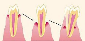 Anti-arthritics can exacerbate other inflammatory diseases like periodontitis